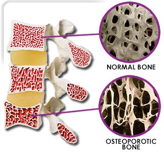 Bone Health